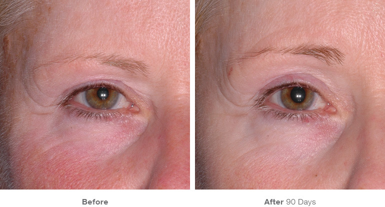 Karesculpt Kare Plastic Surgery Eyebrow Lift with Ultherapy