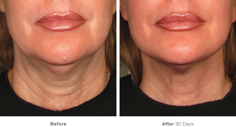Ultherapy Before and After Photos for Neck Lift in Santa Monica at Karesculpt on Montana Avenue 