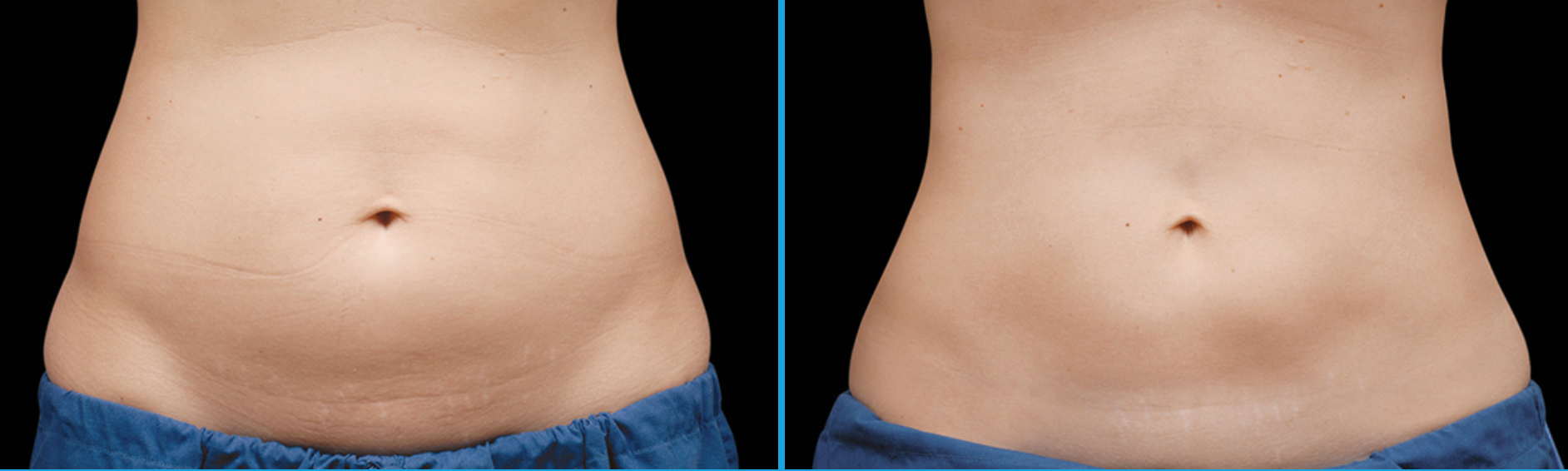 Coolsculpting Abdomen Before and After in Santa Monica