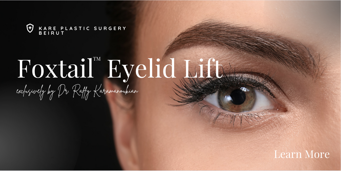 Foxtail Eyelid Lift blepharoplasty in Kare Beirut Plastic Surgery