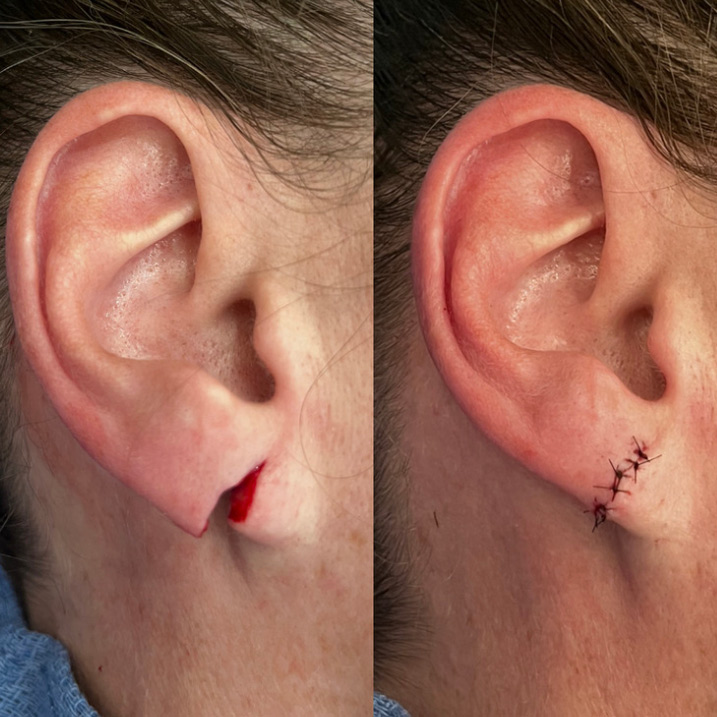 Stretched and torn earlobe repair before and after by Dr. Raffy Karamanoukian at Kare Plastic Surgery showing severely stretched and partially torn earlobe before surgery and repaired earlobe with suture closure after in-office earlobe repair procedure