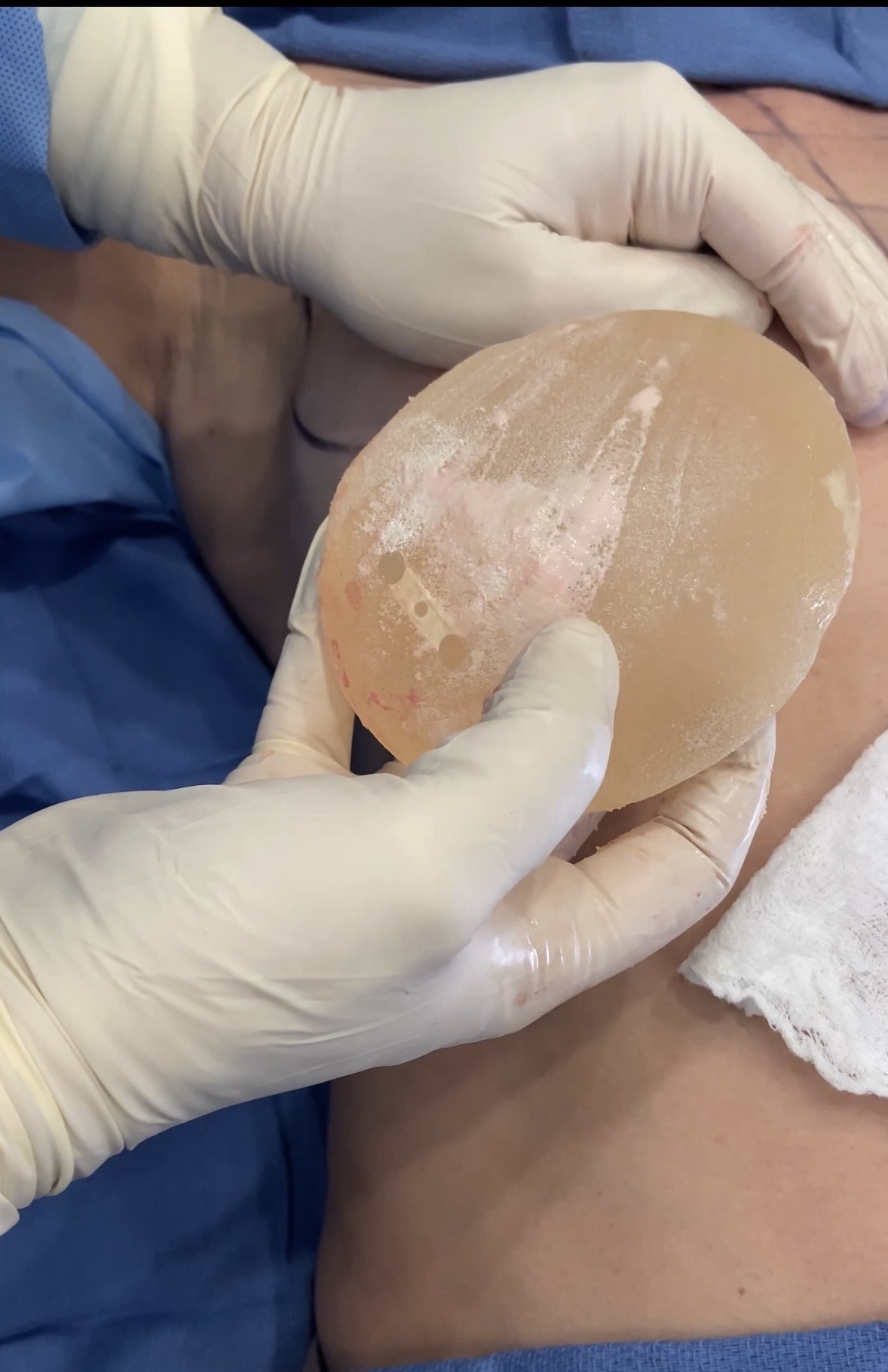 Intraoperative removal of problematic breast implant with capsular contracture surface biofilm at Kare Plastic Surgery by American board certified plastic surgeon Dr. Raffy Karamanoukian showing explanted silicone gel breast implant with surface inflammatory material consistent with biofilm contamination and capsular contracture
