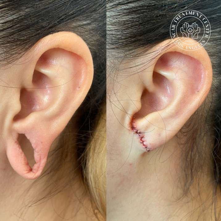 Torn earlobe repair before and after by Dr. Raffy Karamanoukian at Kare Plastic Surgery showing completely split torn earlobe before surgery and repaired earlobe with fine suture closure immediately after in-office torn earlobe repair procedure under local anesthesia